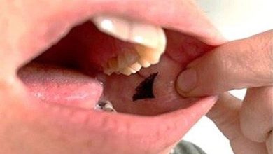 پچ انسولین در دهان