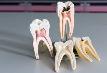 درمان ریشه دندان